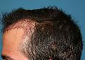 Click image for larger version

Name:	Immed. Post-Op - Left.jpg
Views:	355
Size:	90.2 KB
ID:	458089
