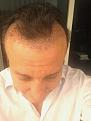 Click image for larger version

Name:	Hair Transplant day five.jpg
Views:	522
Size:	88.3 KB
ID:	458254