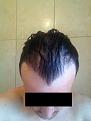 Click image for larger version

Name:	Front Pre-Op (Wet).jpg
Views:	1565
Size:	91.0 KB
ID:	458805