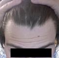 Click image for larger version

Name:	hairlineangle2012.jpg
Views:	33702
Size:	31.5 KB
ID:	458853