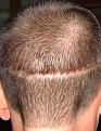Click image for larger version

Name:	Day 8 scar [1].JPG
Views:	422
Size:	48.4 KB
ID:	458944