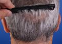 Click image for larger version

Name:	6. Back Trichophytic Scar_ 5 Months.JPG
Views:	485
Size:	83.5 KB
ID:	459044