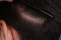 Click image for larger version

Name:	11. Trichophytic Scar.JPG
Views:	407
Size:	72.5 KB
ID:	459067