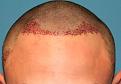 Click image for larger version

Name:	Immediate Post-Op - Front.jpg
Views:	563
Size:	79.1 KB
ID:	459573