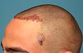 Click image for larger version

Name:	Immed Post-Op Left.jpg
Views:	511
Size:	93.1 KB
ID:	459575