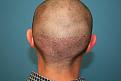 Click image for larger version

Name:	Immed. Post-Op Donor Site Scar.jpg
Views:	550
Size:	85.8 KB
ID:	459579