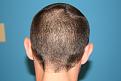 Click image for larger version

Name:	Donor Site Scar - After.jpg
Views:	582
Size:	82.2 KB
ID:	459580