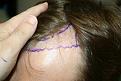 Click image for larger version

Name:	Pre op 3.jpg
Views:	686
Size:	94.0 KB
ID:	459741
