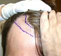 Click image for larger version

Name:	pre op 5.jpg
Views:	647
Size:	52.8 KB
ID:	459743