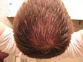 Click image for larger version

Name:	Nov 2010_6 mos Rogaine (15) copy.jpg
Views:	3627
Size:	90.7 KB
ID:	459885