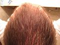 Click image for larger version

Name:	Nov 2010_Rogaine 6 mos(9) copy.jpg
Views:	700
Size:	86.0 KB
ID:	459887