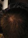 Click image for larger version

Name:	Feb 2011 9 mos Rogaine (18) copy.jpg
Views:	684
Size:	90.6 KB
ID:	459891