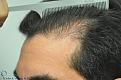 Click image for larger version

Name:	LB_Hairline Before.jpg
Views:	723
Size:	93.4 KB
ID:	460118