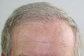 Click image for larger version

Name:	6 Months Post-Op - Front 2.jpg
Views:	261
Size:	92.8 KB
ID:	462600