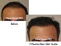 Click image for larger version

Name:	Hair Transplant Slides.003.jpg
Views:	417
Size:	62.6 KB
ID:	462769