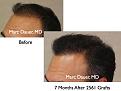 Click image for larger version

Name:	Hair Transplant Slides.004.jpg
Views:	368
Size:	63.6 KB
ID:	462770