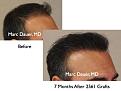 Click image for larger version

Name:	Hair Transplant Slides.005.jpg
Views:	384
Size:	66.7 KB
ID:	462771