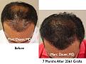 Click image for larger version

Name:	Hair Transplant Slides.006.jpg
Views:	443
Size:	85.5 KB
ID:	462772