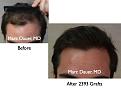 Click image for larger version

Name:	Hair Transplant Slides.007.jpg
Views:	406
Size:	58.7 KB
ID:	462820