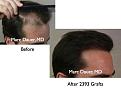 Click image for larger version

Name:	Hair Transplant Slides.008.jpg
Views:	420
Size:	57.3 KB
ID:	462821