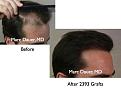 Click image for larger version

Name:	Hair Transplant Slides.008.jpg
Views:	515
Size:	57.3 KB
ID:	462821