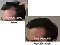 Click image for larger version

Name:	Hair Transplant Slides.009.jpg
Views:	365
Size:	54.6 KB
ID:	462822