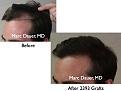 Click image for larger version

Name:	Hair Transplant Slides.009.jpg
Views:	450
Size:	54.6 KB
ID:	462822