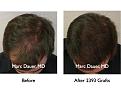 Click image for larger version

Name:	Hair Transplant Slides.010.jpg
Views:	392
Size:	70.6 KB
ID:	462823