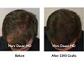 Click image for larger version

Name:	Hair Transplant Slides.010.jpg
Views:	482
Size:	70.6 KB
ID:	462823