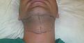 Click image for larger version

Name:	10-Before-beard donor area.jpg
Views:	661
Size:	50.4 KB
ID:	462904