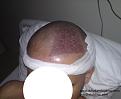 Click image for larger version

Name:	11-1th day 1800 grafts.jpg
Views:	639
Size:	31.7 KB
ID:	462905