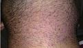 Click image for larger version

Name:	18-5th day beard donor area.jpg
Views:	624
Size:	78.1 KB
ID:	462911