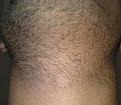 Click image for larger version

Name:	25-2.5 weeks after surgery.jpg
Views:	595
Size:	65.7 KB
ID:	462918