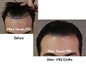 Click image for larger version

Name:	Hair Transplant Slides.011.jpg
Views:	418
Size:	56.2 KB
ID:	462962