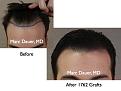 Click image for larger version

Name:	Hair Transplant Slides.011.jpg
Views:	497
Size:	56.2 KB
ID:	462962