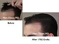 Click image for larger version

Name:	Hair Transplant Slides.012.jpg
Views:	388
Size:	55.4 KB
ID:	462963