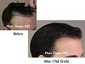 Click image for larger version

Name:	Hair Transplant Slides.013.jpg
Views:	468
Size:	60.4 KB
ID:	462964