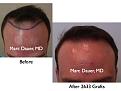 Click image for larger version

Name:	Hair Transplant Slides.014.jpg
Views:	327
Size:	56.8 KB
ID:	463168