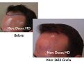 Click image for larger version

Name:	Hair Transplant Slides.015.jpg
Views:	252
Size:	54.4 KB
ID:	463169