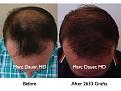 Click image for larger version

Name:	Hair Transplant Slides.017.jpg
Views:	327
Size:	77.3 KB
ID:	463171
