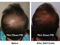 Click image for larger version

Name:	Hair Transplant Slides.018.jpg
Views:	318
Size:	78.5 KB
ID:	463172