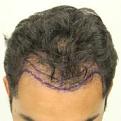 Click image for larger version

Name:	Pre-op.jpg
Views:	575
Size:	6.7 KB
ID:	463178