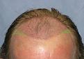 Click image for larger version

Name:	bernstein-hair-transplant-sites1.jpg
Views:	440
Size:	21.7 KB
ID:	463514