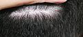 Click image for larger version

Name:	Donor Scar Area - 2.jpg
Views:	237
Size:	105.6 KB
ID:	463649