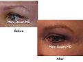 Click image for larger version

Name:	Hair Transplant Slides.022.jpg
Views:	715
Size:	53.2 KB
ID:	463714