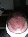 Click image for larger version

Name:	Immed Post op.jpg
Views:	516
Size:	9.8 KB
ID:	463757