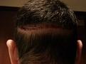 Click image for larger version

Name:	scar after staples removed.jpg
Views:	512
Size:	19.9 KB
ID:	463759