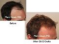 Click image for larger version

Name:	Hair Transplant Slides5.039.jpg
Views:	1284
Size:	56.9 KB
ID:	463782