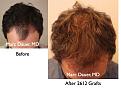 Click image for larger version

Name:	Hair Transplant Slides5.040.jpg
Views:	342
Size:	73.6 KB
ID:	463783