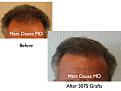 Click image for larger version

Name:	Hair Transplant Slides6.044.jpg
Views:	414
Size:	70.1 KB
ID:	463784